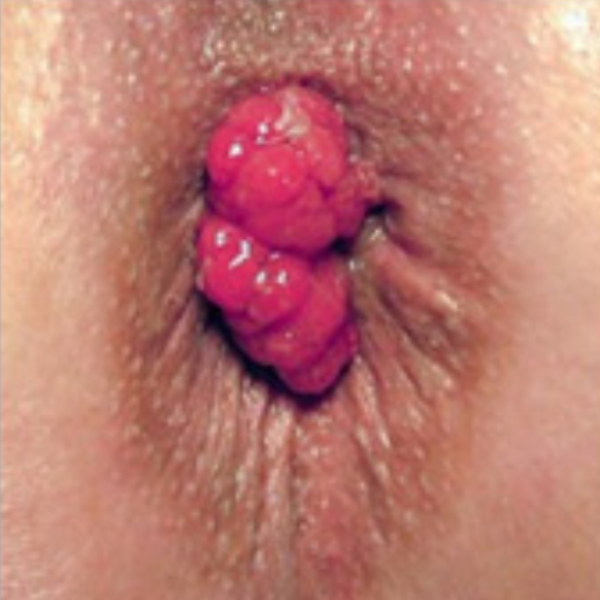 Prolapsed Internal Hemorrhoid