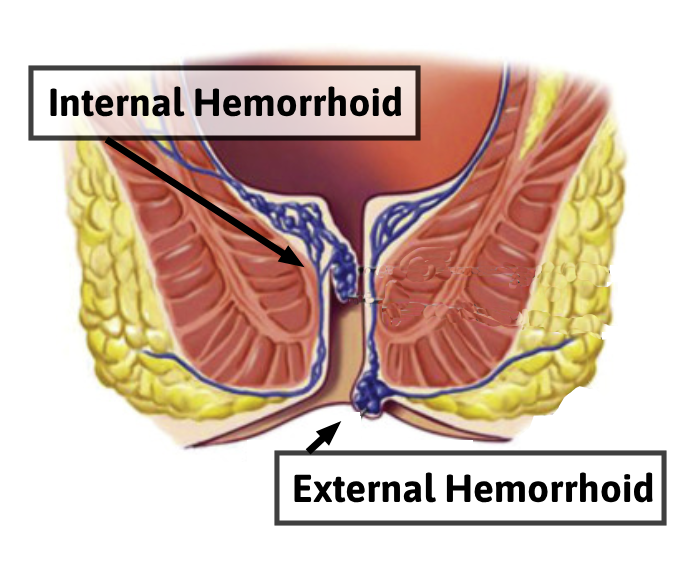Hemorrhoids