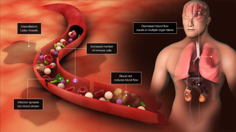 Pathology of Sepsis