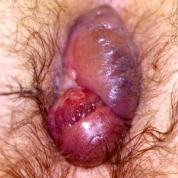 Prolasped Stage IV Hemorrhoid